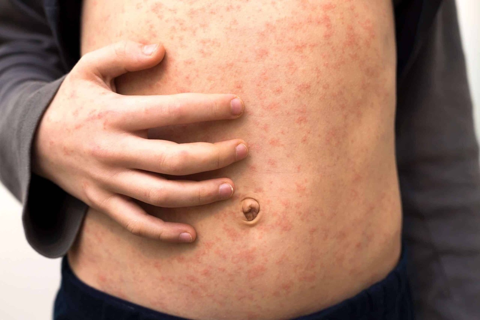 Newsless residents do not give positive for measles after dying